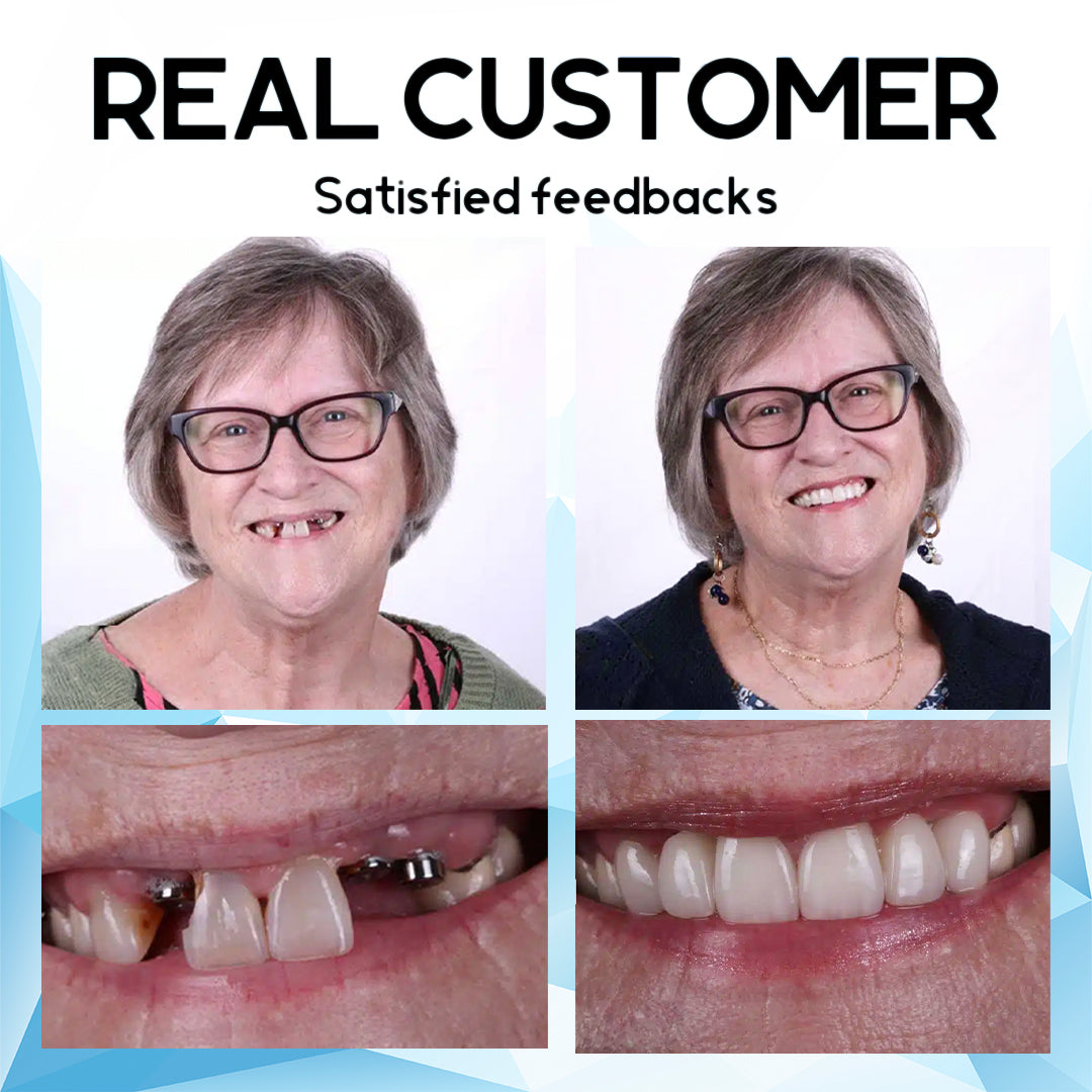 AEXZRโข Silicone Reline Denture Set(โฐ๐๐ข๐ฆ๐ข๐ญ๐๐ ๐ญ๐ข๐ฆ๐ ๐๐ข๐ฌ๐๐จ๐ฎ๐ง๐ญ ๐๐๐ฌ๐ญ ๐๐ ๐ฆ๐ข๐ง๐ฎ๐ญ๐๐ฌโฐ)