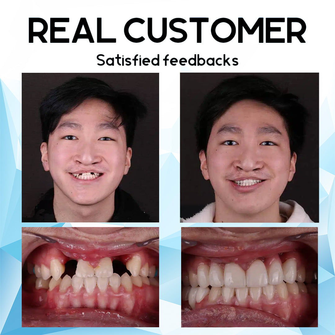 AEXZRโข Silicone Reline Denture Set(โฐ๐๐ข๐ฆ๐ข๐ญ๐๐ ๐ญ๐ข๐ฆ๐ ๐๐ข๐ฌ๐๐จ๐ฎ๐ง๐ญ ๐๐๐ฌ๐ญ ๐๐ ๐ฆ๐ข๐ง๐ฎ๐ญ๐๐ฌโฐ)