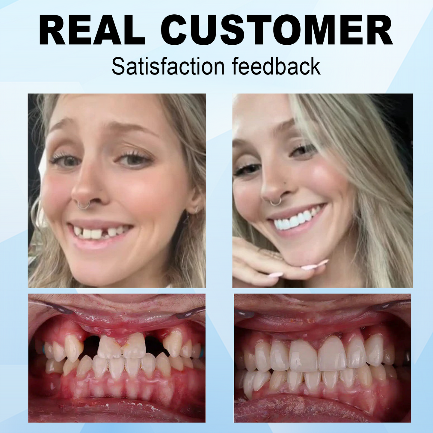Dobshow™⏰𝕤𝕒𝕧𝕖 𝕦𝕡 𝕥𝕠 -6️⃣8️⃣%🔥Silicone Denture Repair Kit🦷