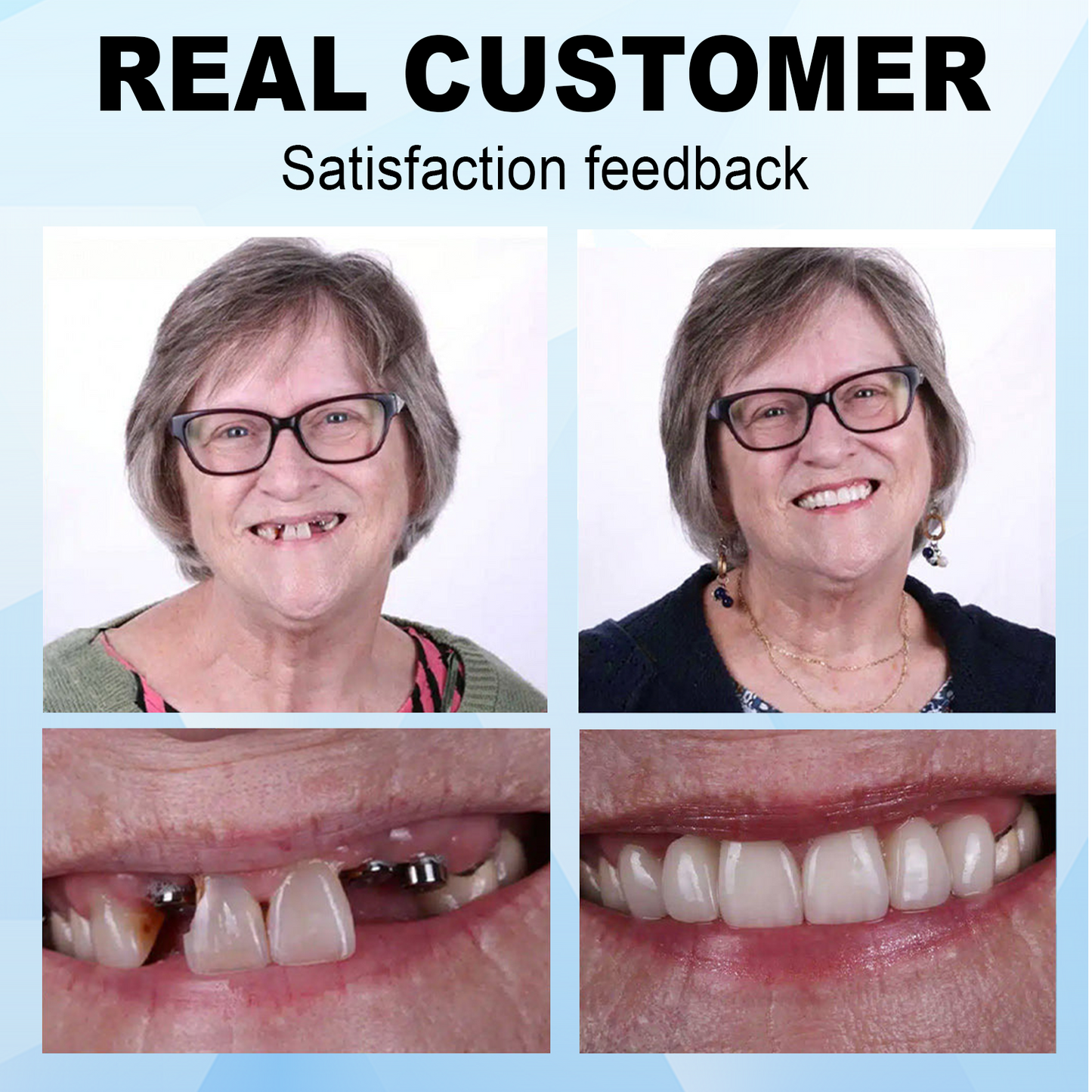 Dobshow™⏰𝕤𝕒𝕧𝕖 𝕦𝕡 𝕥𝕠 -6️⃣8️⃣%🔥Silicone Denture Repair Kit🦷