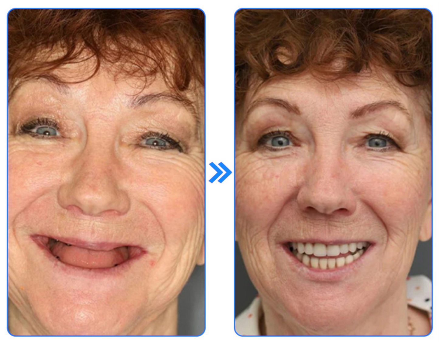 Dobshowā¢š„Buy 1 Get 1 Freeš„- Thermoplastic Denture Adhesiveš¦·