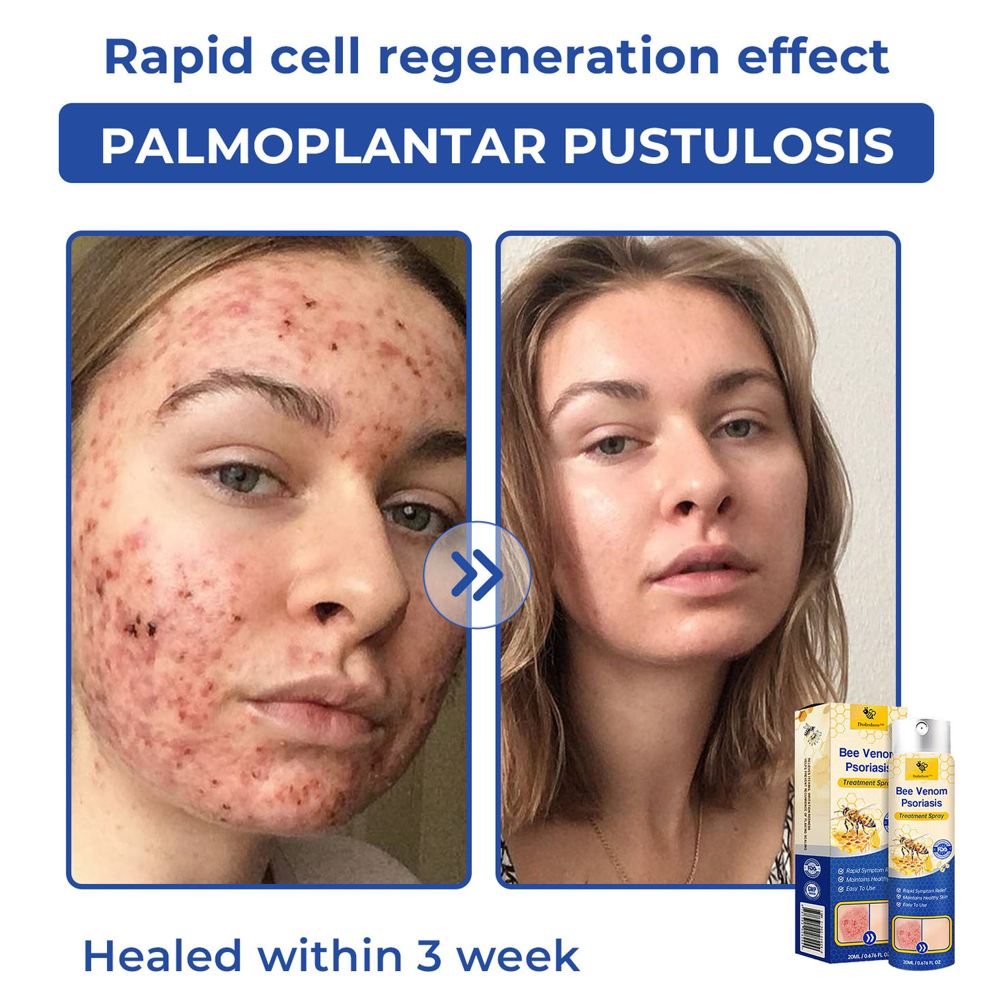 🐝🐝Dobshow™ Bee Venom Psoriasis Treatment Spray🛡️