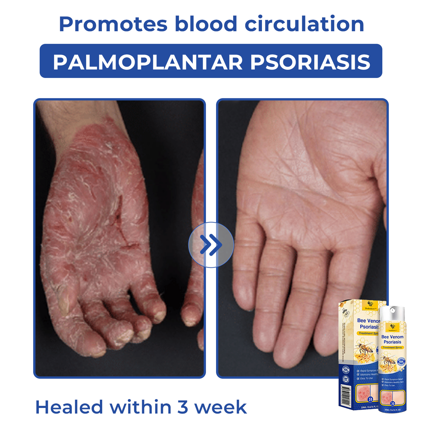 🐝🐝Dobshow™ Bee Venom Psoriasis Treatment Spray🛡️