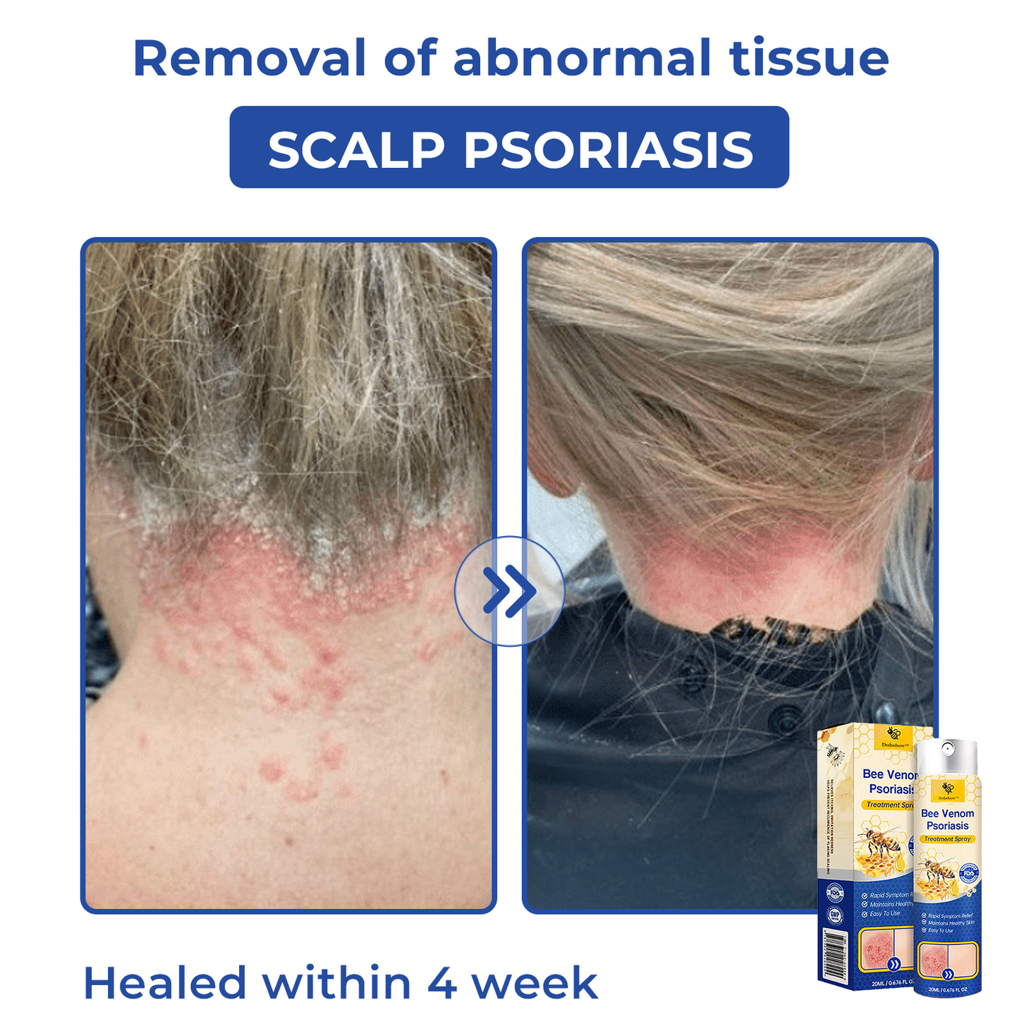 🐝🐝Dobshow™ Bee Venom Psoriasis Treatment Spray🛡️