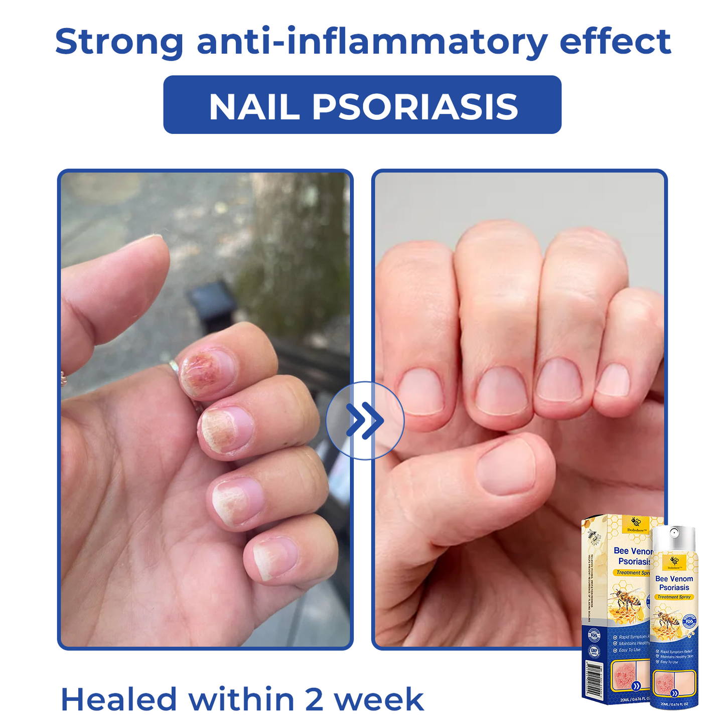 🐝🐝Dobshow™ Bee Venom Psoriasis Treatment Spray🛡️