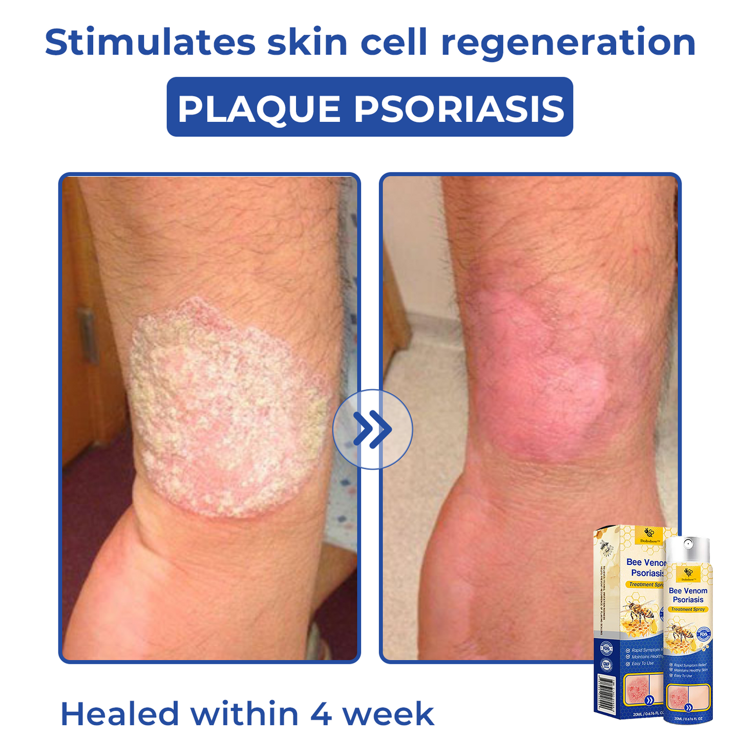 🐝🐝Dobshow™ Bee Venom Psoriasis Treatment Spray🛡️