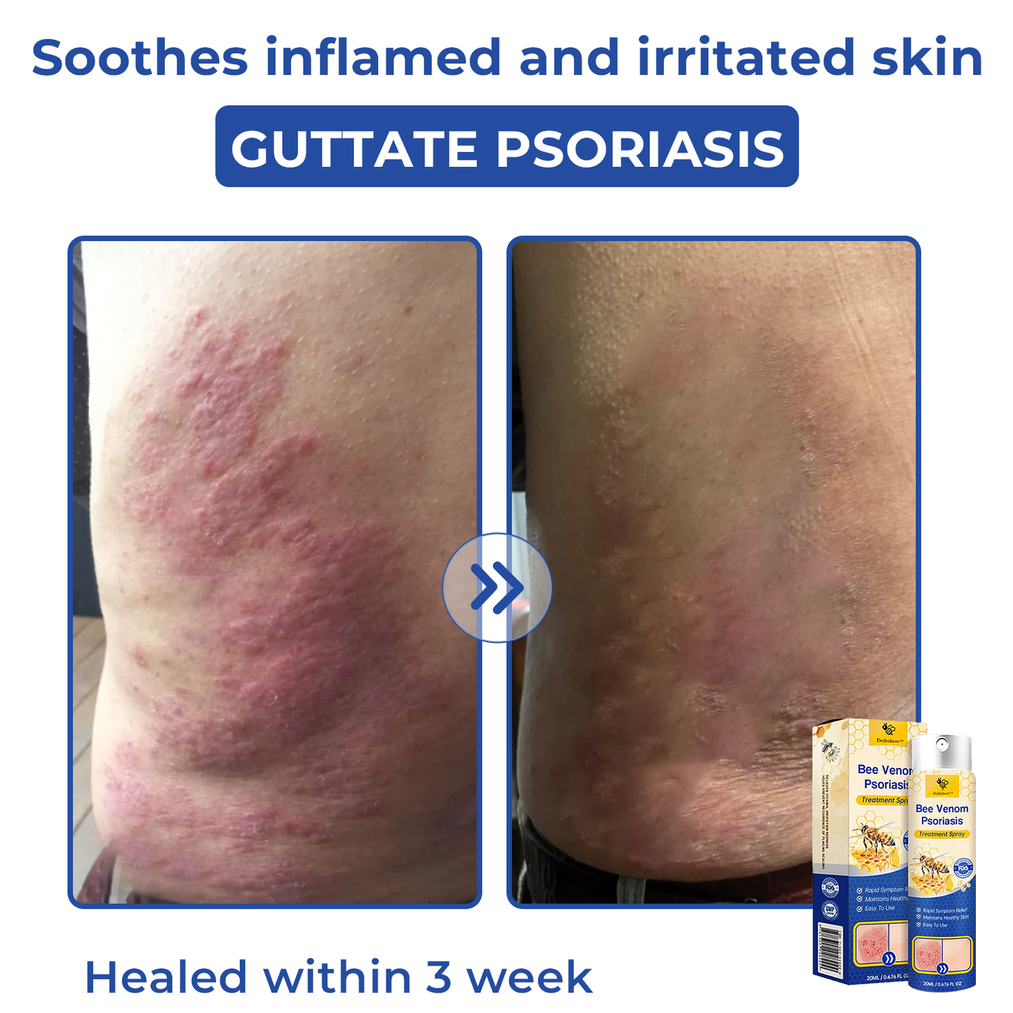 🐝🐝Dobshow™ Bee Venom Psoriasis Treatment Spray🛡️