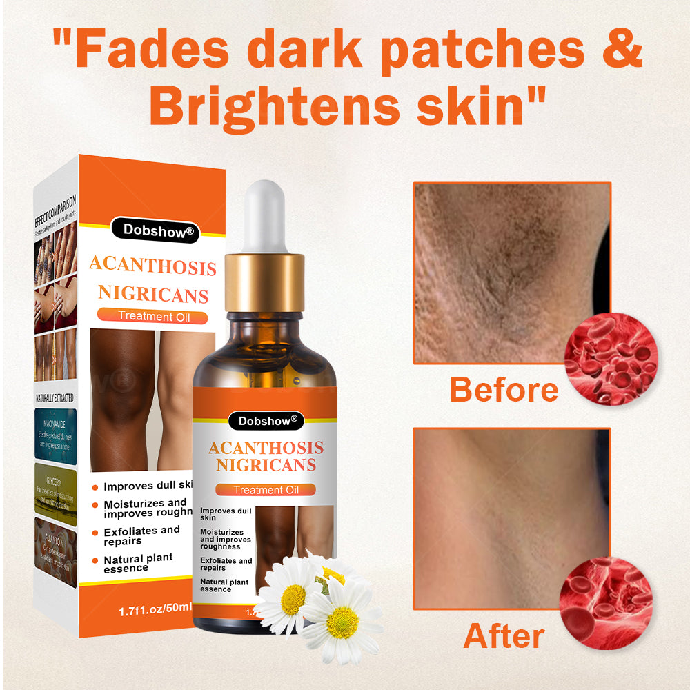 Dobshow® Acanthosis Nigricans Treatment Oil