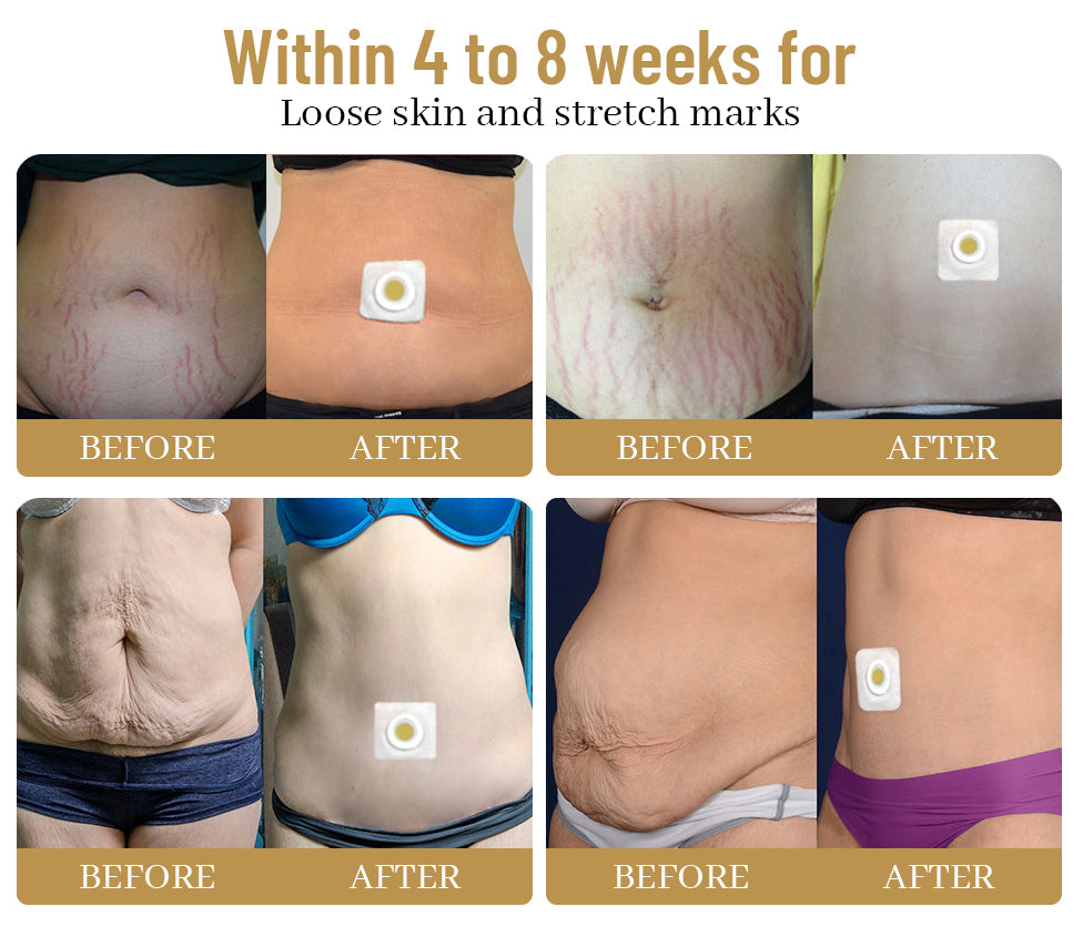 🙋♀️🙋♀️ Dobshow™ Bee Venom Slimming Patches 10pcs - for all lymphatic and health problems