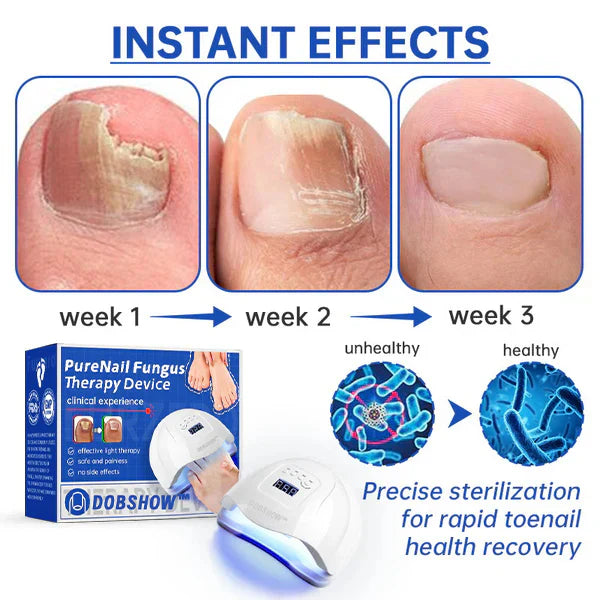 Dobshow™ PureNail Fungus Laser Therapy Device