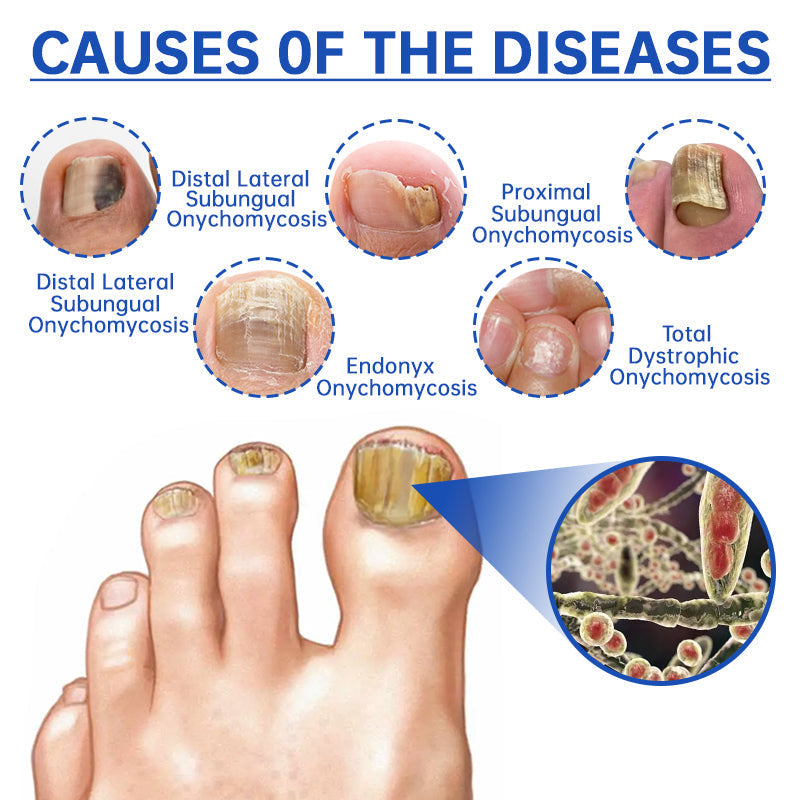 Dobshow™ PureNail Fungus Laser Therapy Device