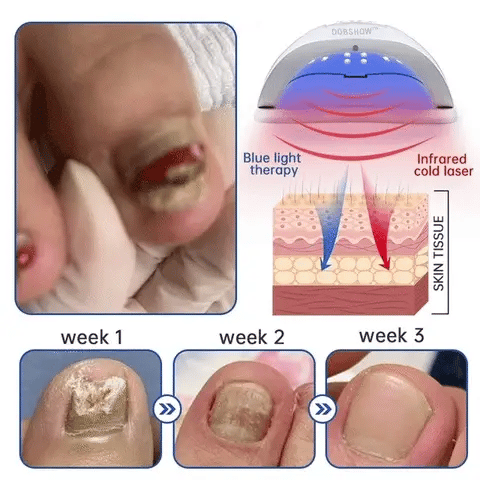Dobshow™ PureNail Fungus Laser Therapy Device