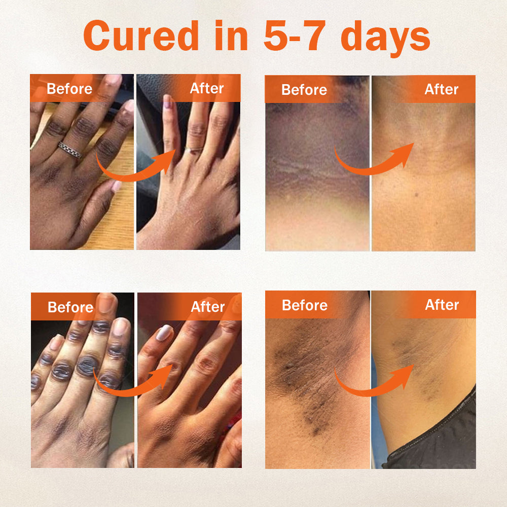 Dobshow® Acanthosis Nigricans Treatment Oil