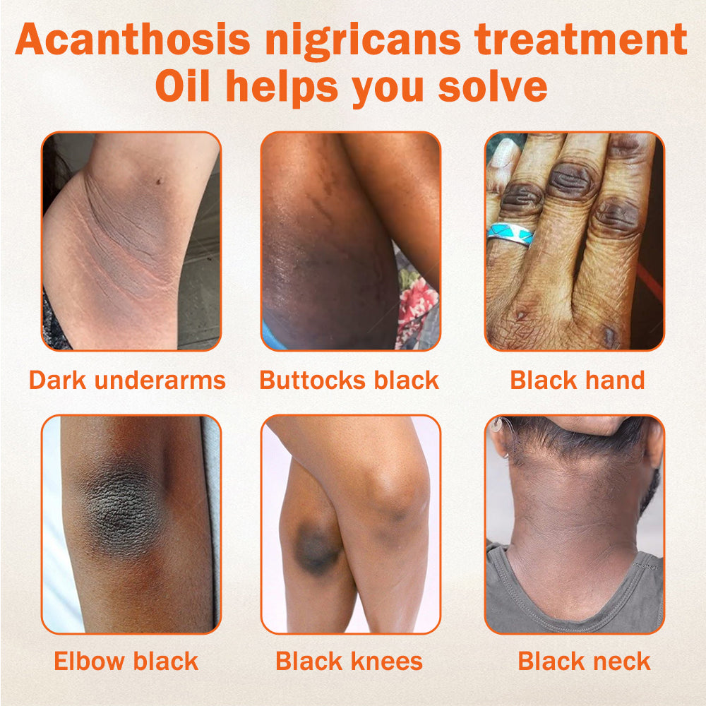 Dobshow® Acanthosis Nigricans Treatment Oil