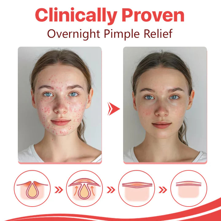 ⭐ Nurbini™ Star pimple patch ⭐