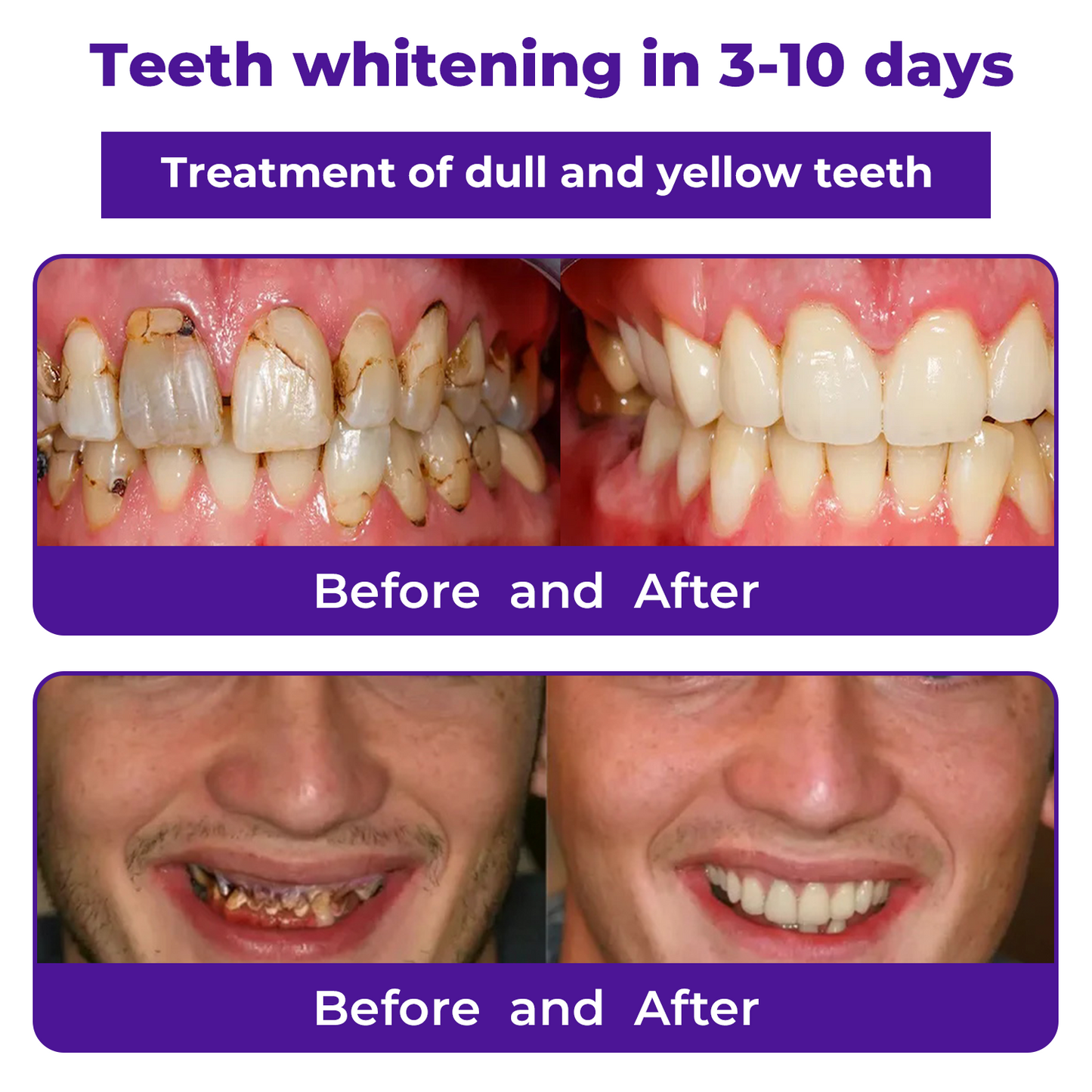 š¦·Dobshow⢠Dental Repair Mineral Powder >>š„ 1 + 1 Offerš„