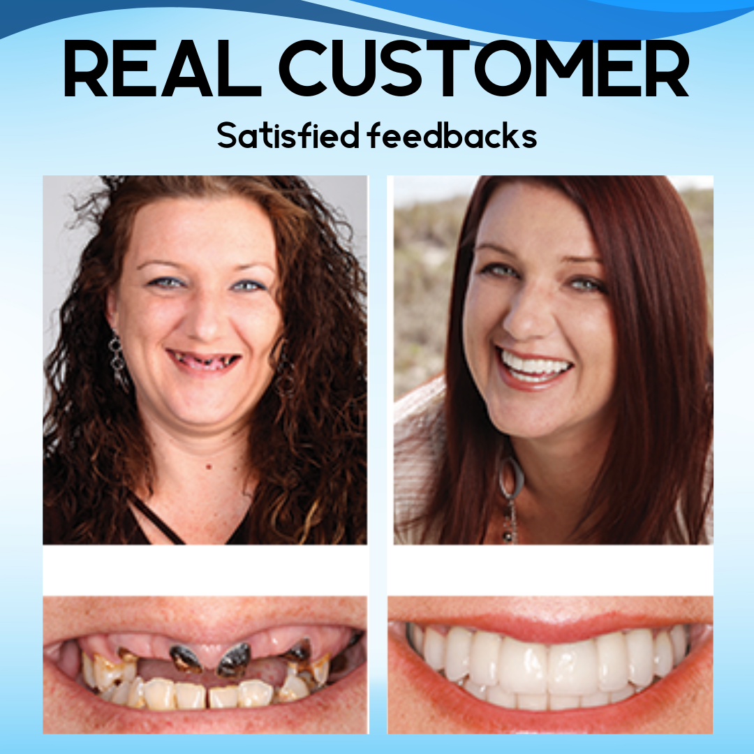 AEXZRโข Silicone Reline Denture Set(โฐ๐๐ข๐ฆ๐ข๐ญ๐๐ ๐ญ๐ข๐ฆ๐ ๐๐ข๐ฌ๐๐จ๐ฎ๐ง๐ญ ๐๐๐ฌ๐ญ ๐๐ ๐ฆ๐ข๐ง๐ฎ๐ญ๐๐ฌโฐ)