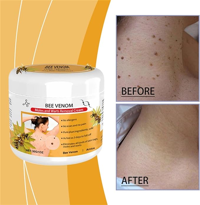 🐝🐝 Dobshow™Bee Venom Mole and Wart Treatment Cream(👨⚕AAD RECOMMENDS)