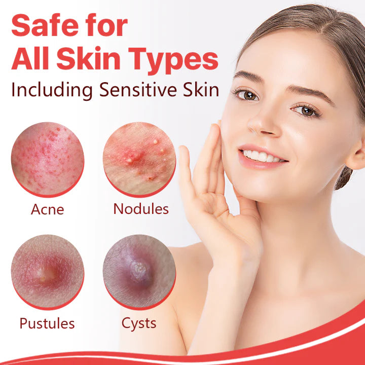 ⭐ Nurbini™ Star pimple patch ⭐