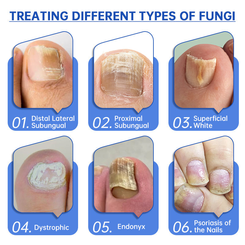 Dobshow™ PureNail Fungus Laser Therapy Device