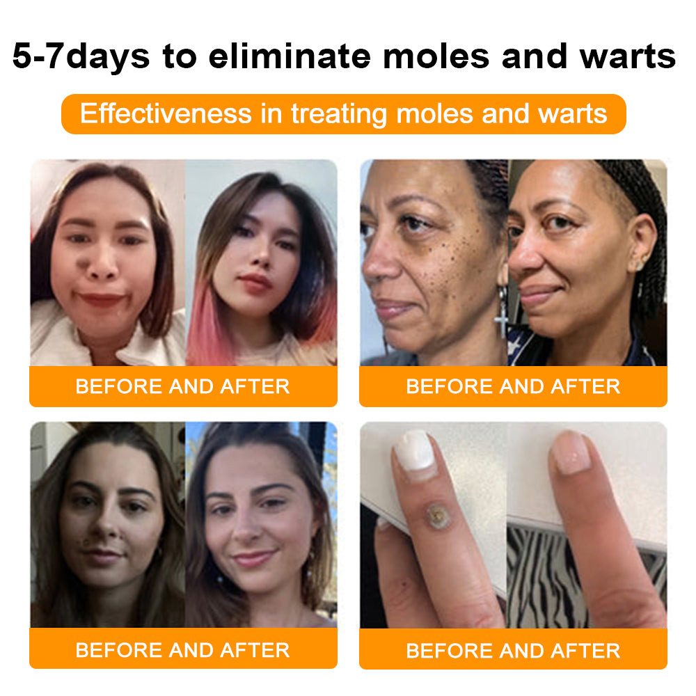 đđ Dobshowâ˘Bee Venom Mole and Wart Treatment Cream