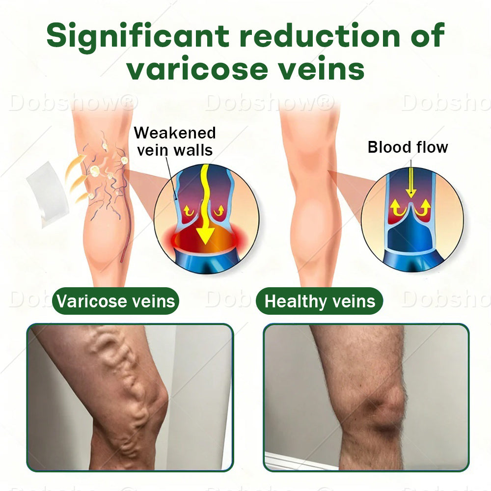 🎁𝙇𝙞𝙢𝙞𝙩𝙚𝙙-𝙩𝙞𝙢𝙚 𝙊𝙛𝙛𝙚𝙧🎁Croaie® VeinLock Microneedle Patch