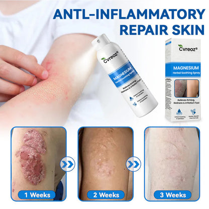 🔥𝙁𝙞𝙣𝙖𝙡 3 𝙃𝙤𝙪𝙧𝙨: 80% 𝙊𝙁𝙁: Cvreoz® Magnesium Herbal Psoriasis Spray⚕️ 𝘍𝘋𝘈 𝘊𝘦𝘳𝘵𝘪𝘧𝘪𝘦𝘥 (𝘧𝘰𝘳 𝘵𝘩𝘦 𝘵𝘳𝘦𝘢𝘵𝘮𝘦𝘯𝘵 𝘰𝘧 𝘱𝘴𝘰𝘳𝘪𝘢𝘴𝘪𝘴 𝘢𝘯𝘥 𝘦𝘤𝘻𝘦𝘮𝘢, 𝘪𝘮𝘱𝘳𝘰𝘷𝘦𝘮𝘦𝘯𝘵 𝘰𝘧 𝘣𝘢𝘤𝘵𝘦𝘳𝘪𝘢𝘭 𝘪𝘯𝘧𝘦𝘤𝘵𝘪𝘰𝘯𝘴 𝘪𝘯 𝘵𝘩𝘦 𝘨𝘦𝘯𝘪𝘵𝘢𝘭 𝘢𝘳𝘦𝘢, 𝘵𝘳𝘦𝘢𝘵𝘮𝘦𝘯𝘵 𝘰𝘧 𝘢𝘤𝘯𝘦 𝘢𝘯𝘥 𝘸𝘢𝘳𝘵𝘴, 𝘦𝘭𝘪𝘮𝘪𝘯𝘢𝘵𝘦𝘴 𝘱𝘴𝘰𝘳𝘪𝘢𝘴𝘪𝘴 𝘢𝘯𝘥 𝘦𝘤𝘻𝘦𝘮𝘢, 𝘦𝘵𝘤.)
