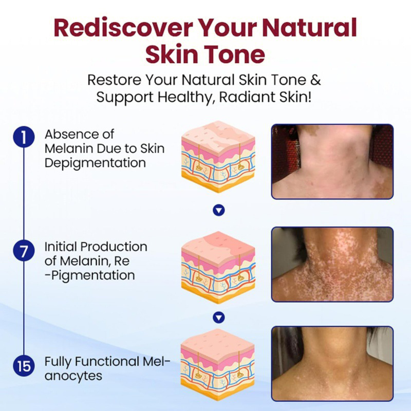 Healrize® Rapid Repair Vitiligo Essence — Visible Results in Weeks, 100% Natural & Steroid-Free