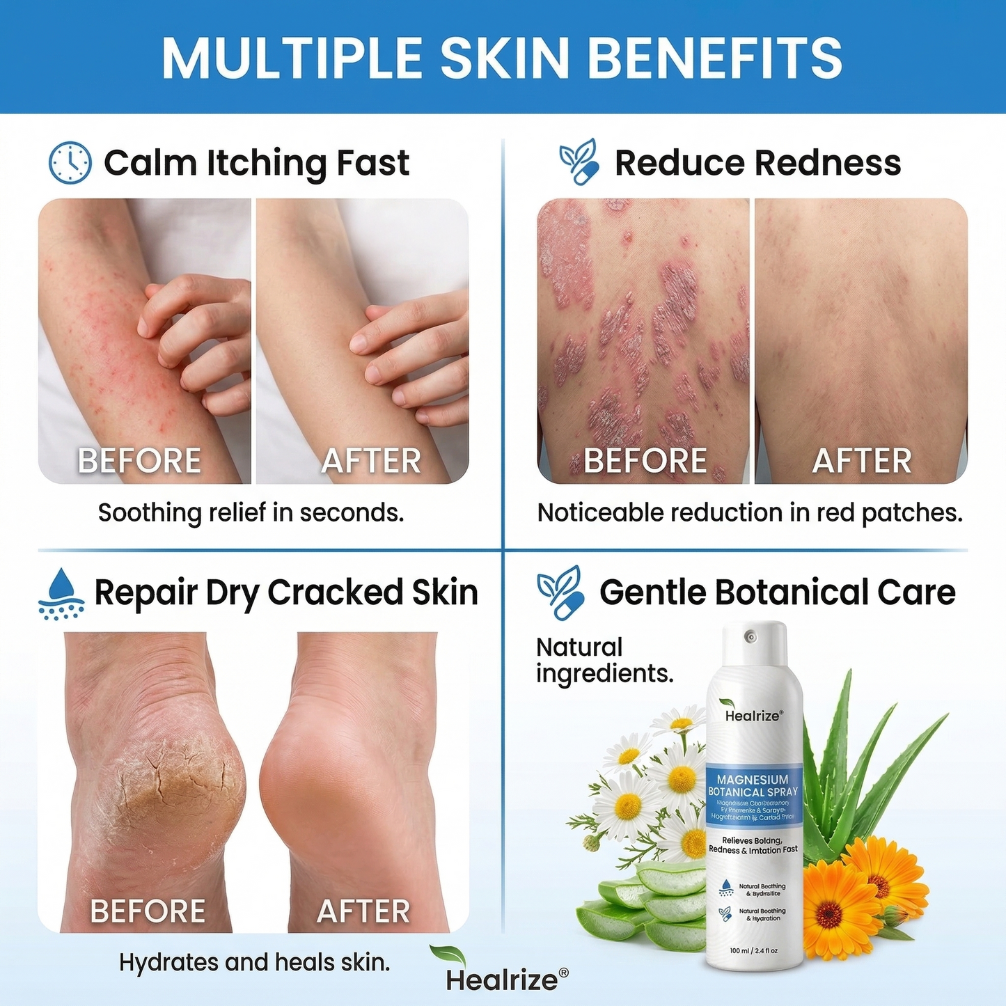 ✨Healrize® Magnesium Botanical Spray – Advanced Skin Recovery for Psoriasis & Eczema | Rapid Soothing, Steroid-Free