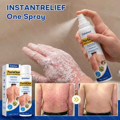 Dobshow® PsoriaClear No-Rub Psoriasis Relief Spray