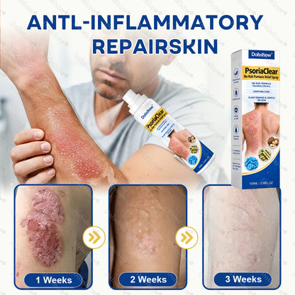 Dobshow® PsoriaClear No-Rub Psoriasis Relief Spray
