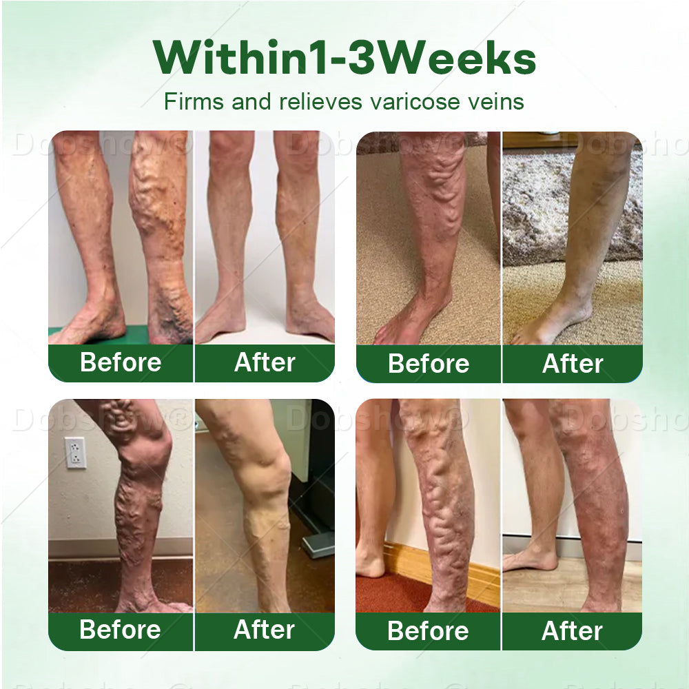 🎁𝙇𝙞𝙢𝙞𝙩𝙚𝙙-𝙩𝙞𝙢𝙚 𝙊𝙛𝙛𝙚𝙧🎁Croaie® VeinLock Microneedle Patch