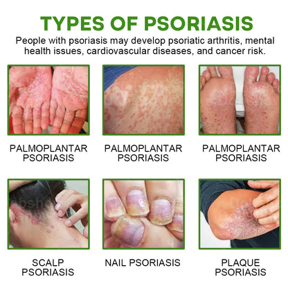 Piguiay® Herbal Psoriasis Relief Cream