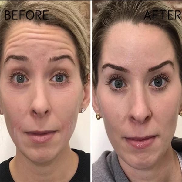 (🔥Last Day Promotion)🔥Nurbini™Luxury Botox Facial- Essence