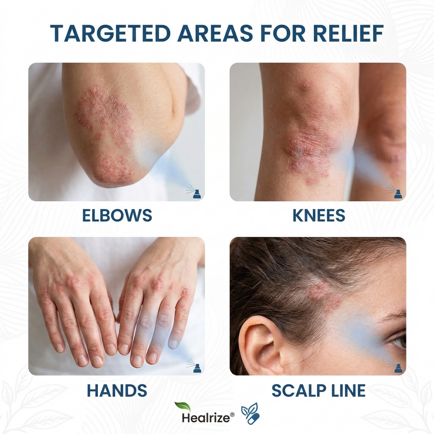 ✨Healrize® Magnesium Botanical Spray – Advanced Skin Recovery for Psoriasis & Eczema | Rapid Soothing, Steroid-Free