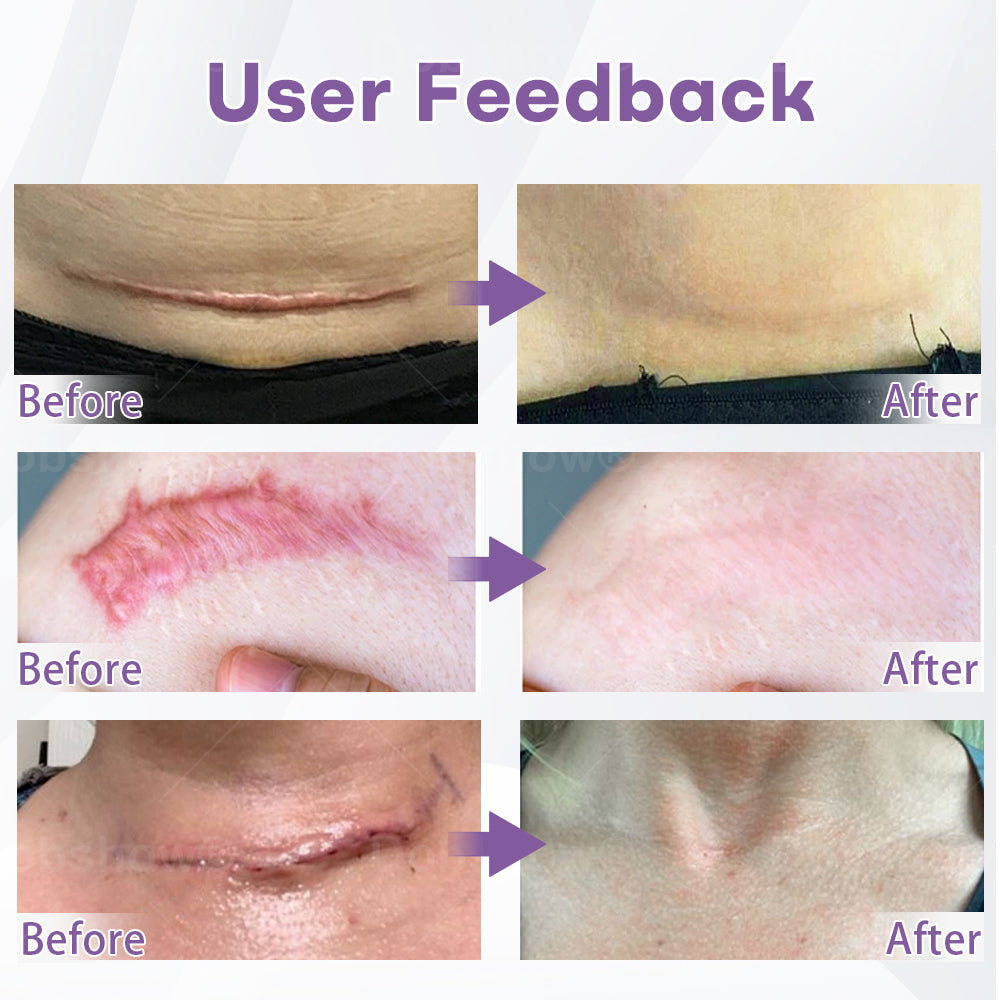 ✅𝗢𝗳𝗳𝗶𝗰𝗶𝗮𝗹 𝗦𝘁𝗼𝗿𝗲 |  𝗗𝗼𝗯𝘀𝗵𝗼𝘄® 𝗡𝗮𝗻𝗼𝗣𝗲𝗻𝗲𝘁𝗿𝗮𝘁𝗲 𝗦𝗸𝗶𝗻 𝗥𝗲𝗻𝗲𝘄 𝗣𝗮𝘁𝗰𝗵 ✴️ Effective for all types of scars, stretch marks, blemishes, keloids, keratosis, acne, burns, warts, skin growths, and varicose veins.