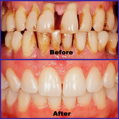 𝗖𝗿𝗼𝗮𝗶𝗲® 𝗩𝗶𝗼𝗧𝗼𝘅 𝗕𝗲𝗲𝗩𝗲𝗻𝗼𝗺 𝗗𝗲𝗻𝘁𝗮𝗹 𝗧𝗵𝗲𝗿𝗮𝗽𝘆 𝗢𝗿𝗮𝗹 𝗣𝗼𝘄𝗲𝗿