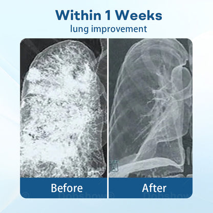 Cvreoz® DoubleNano Advanced Lung Detox Patch for Relief