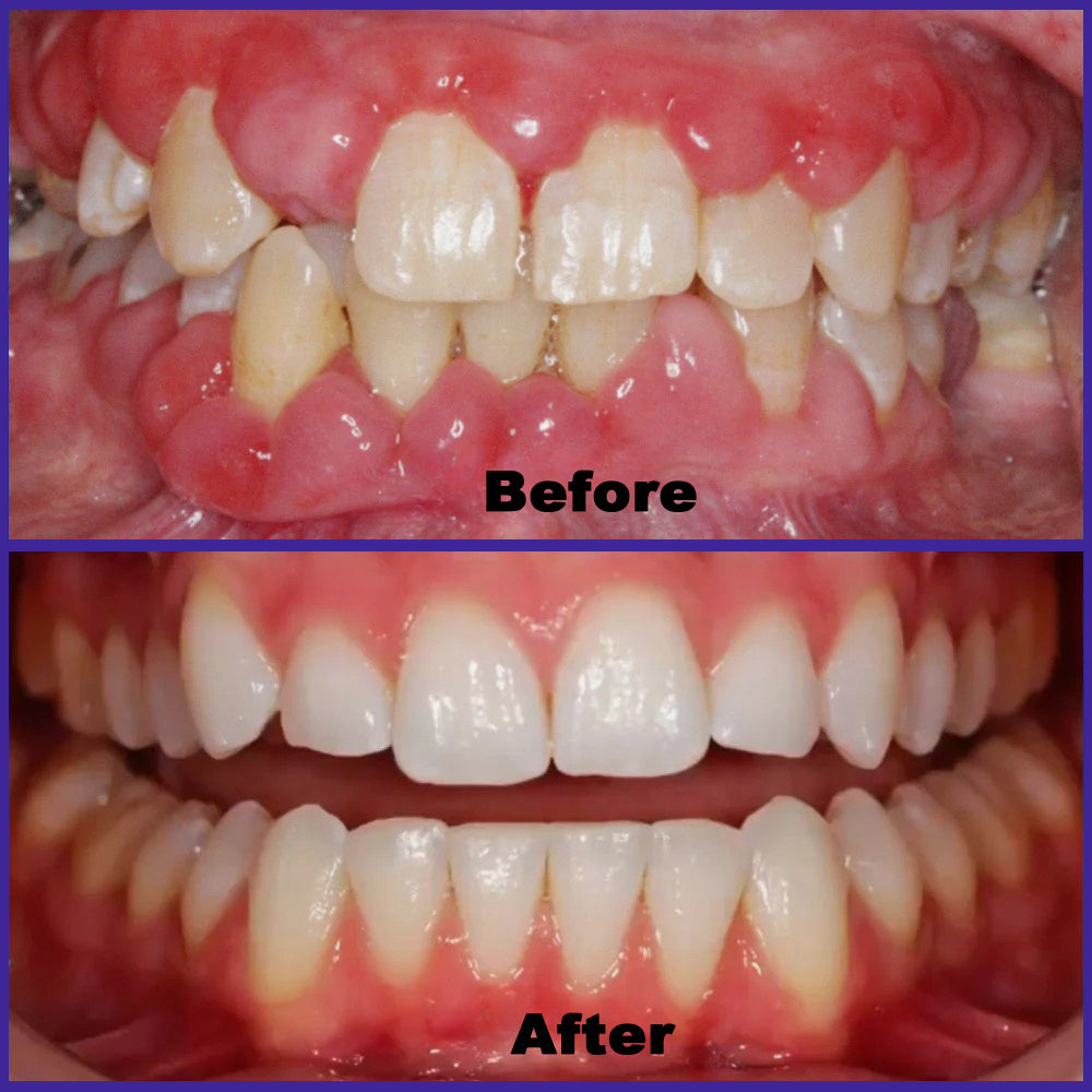 𝗖𝗿𝗼𝗮𝗶𝗲® 𝗩𝗶𝗼𝗧𝗼𝘅 𝗕𝗲𝗲𝗩𝗲𝗻𝗼𝗺 𝗗𝗲𝗻𝘁𝗮𝗹 𝗧𝗵𝗲𝗿𝗮𝗽𝘆 𝗢𝗿𝗮𝗹 𝗣𝗼𝘄𝗲𝗿