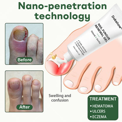 Dobshow® Nail Fungus Renewal Gel