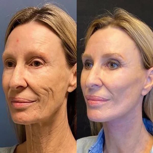 (🔥Last Day Promotion)🔥Nurbini™Luxury Botox Facial- Essence