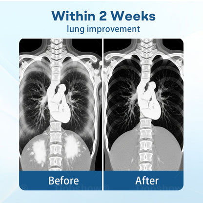 Cvreoz® DoubleNano Advanced Lung Detox Patch for Relief
