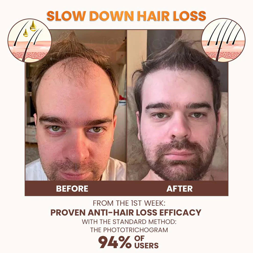Dobshow™ PremiumLocks Biotin Hair & Beard Growth Spray💁‍♀️🧔