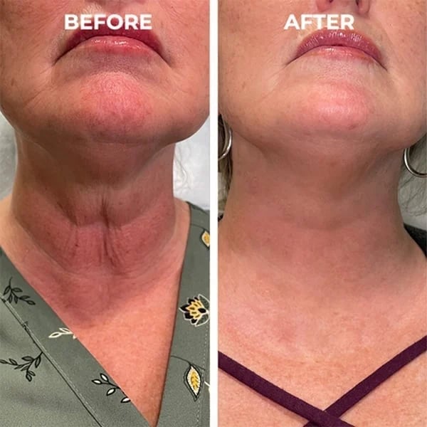 (🔥Last Day Promotion)🔥Nurbini™Luxury Botox Facial- Essence