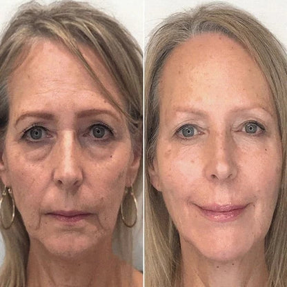 (🔥Last Day Promotion)🔥Nurbini™Luxury Botox Facial- Essence